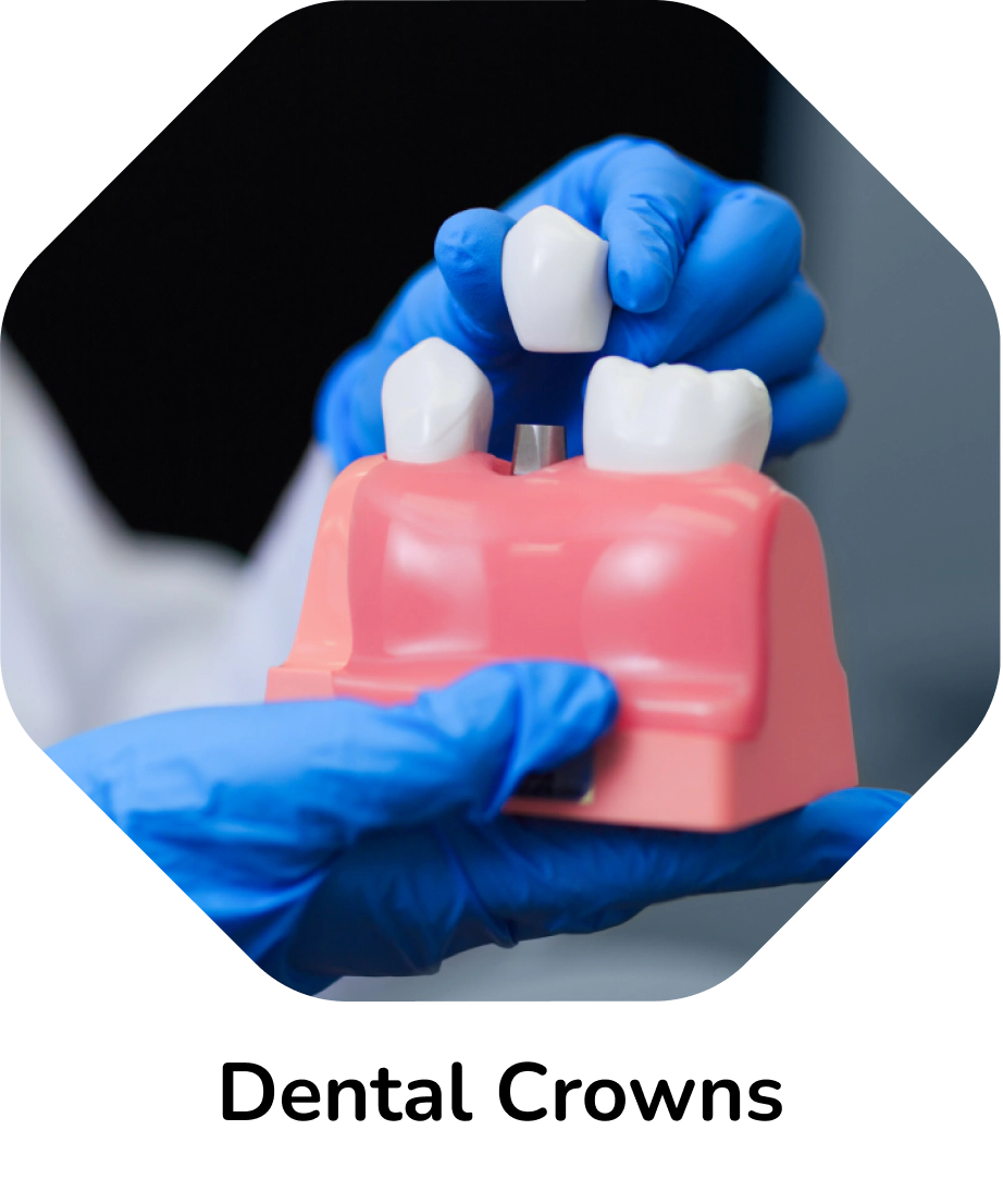 Dental Crowns – gloved hands placing a crown on a dental model