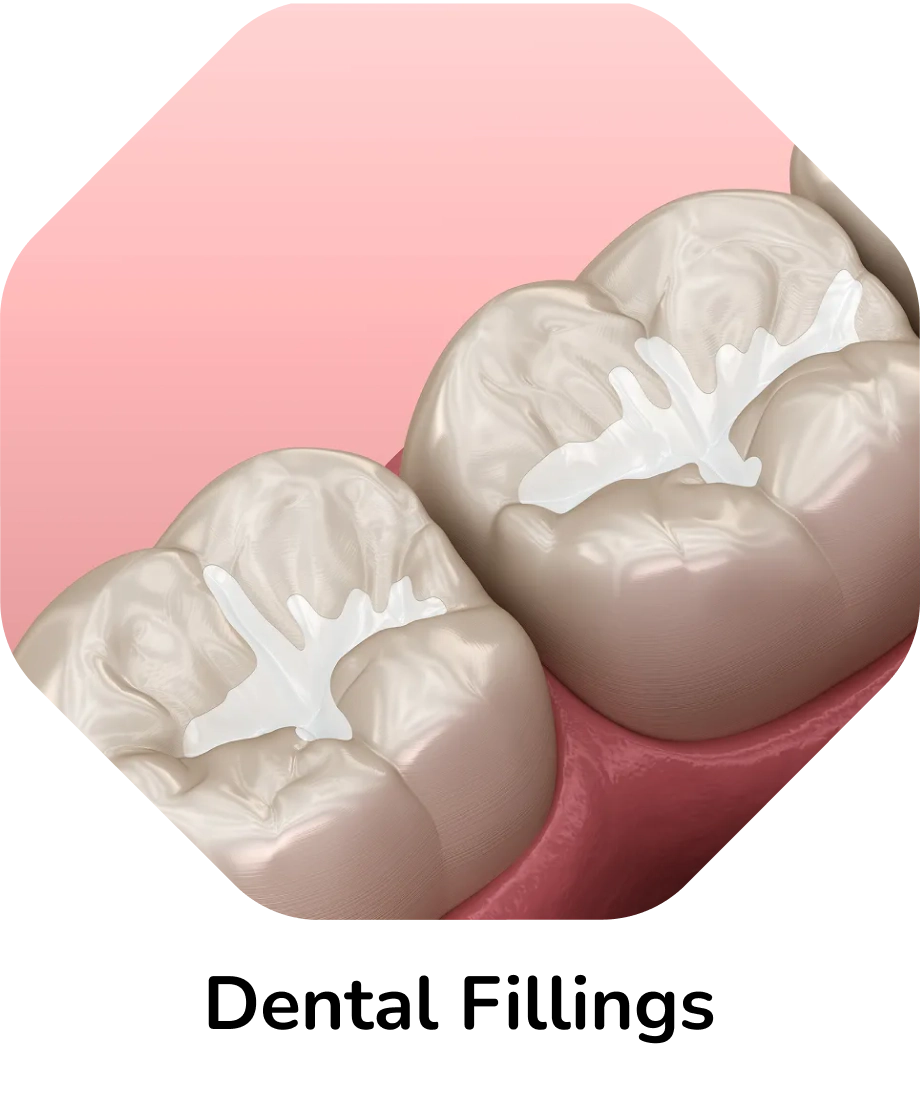Dental Fillings – illustration of molars with tooth-colored fillings